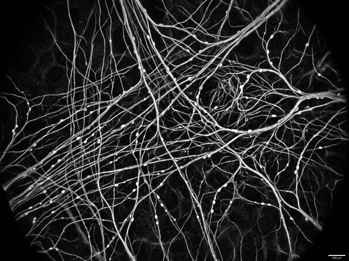 In vivo confocal microscopy of the sub-basal corneal nerve plexus showing dense branching nerve fibers as bright white lines on dark background