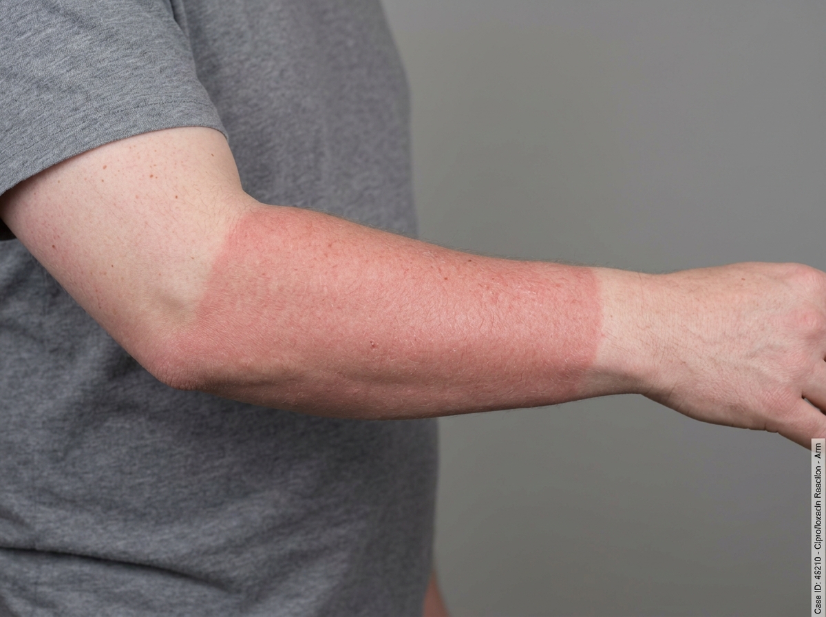 UV-exposed skin on forearm showing ciprofloxacin phototoxic reaction with erythema and slight blistering, contrasted with covered skin