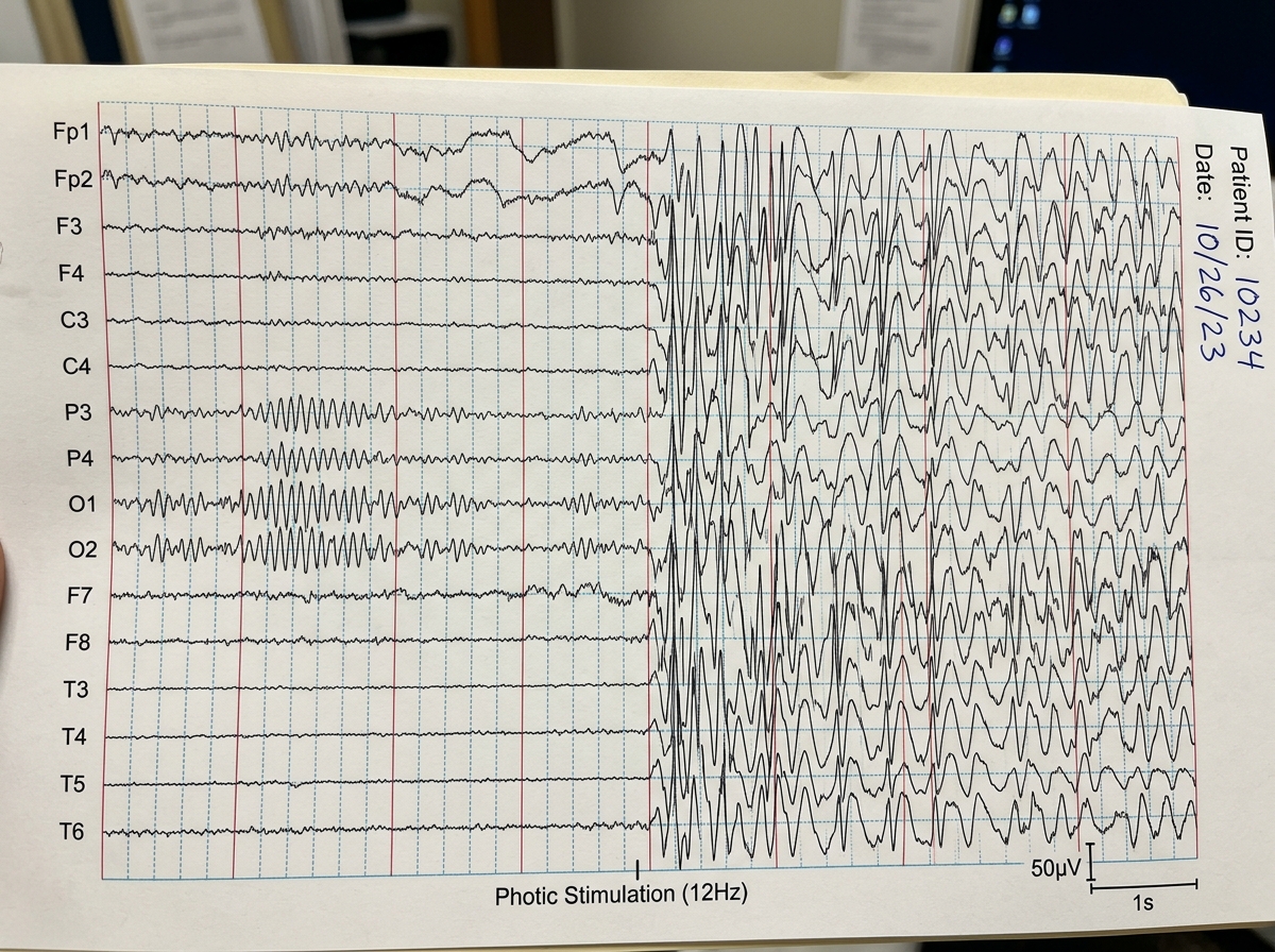 EEG recording showing bilateral photoparoxysmal response (spike-wave discharges) triggered by photic stimulation at 15Hz